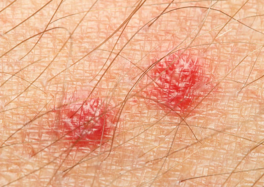 Bed Bugs Are Parasitic and Feed on Your Skin baltimore-bed-bug-bite